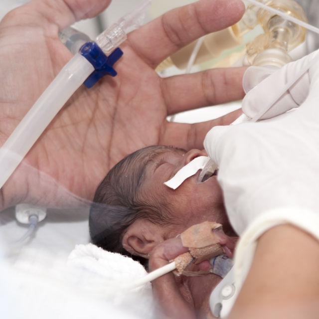 Infant being treated in the NIC